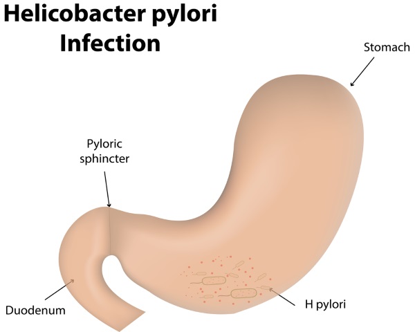 Helicobacter pylori remedii naturiste