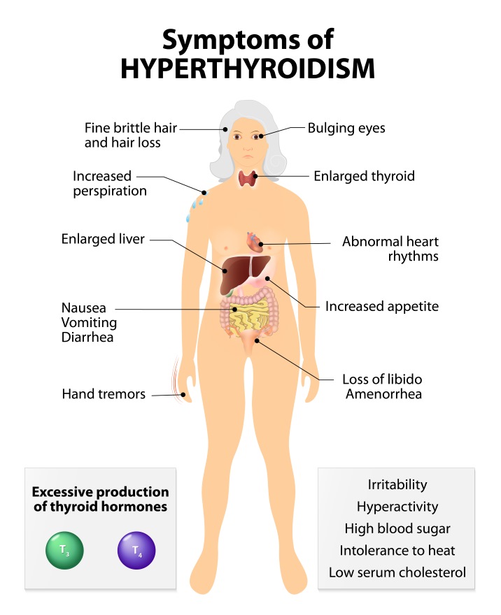 hipertiroidism