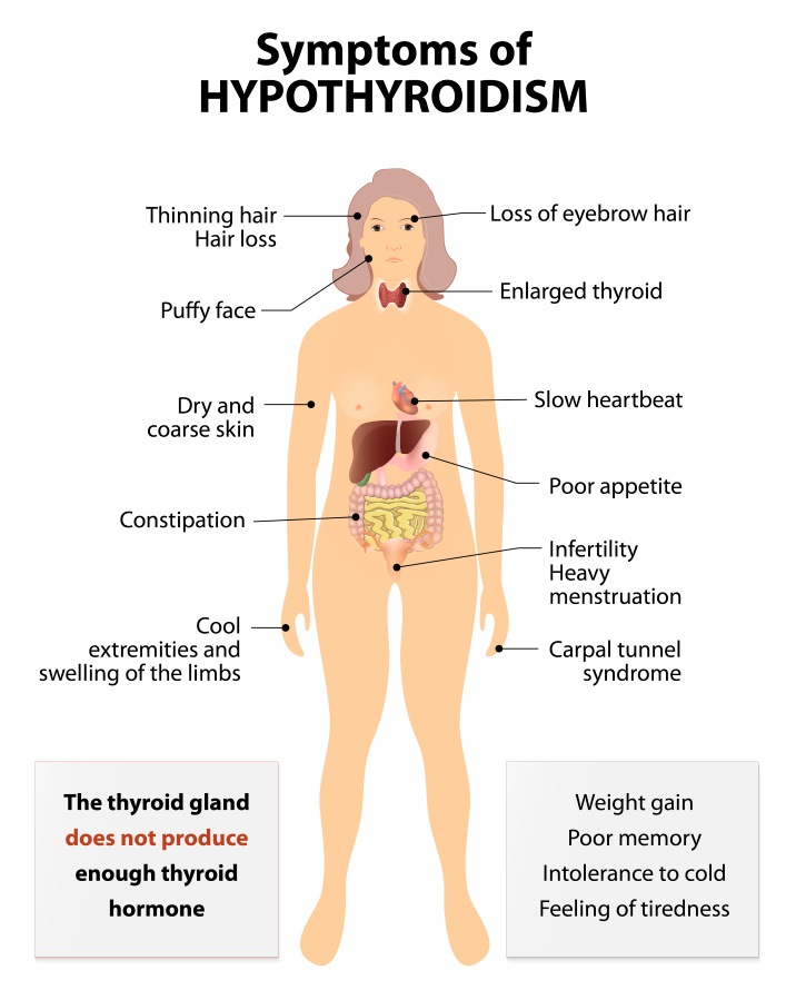 hipotiroidism